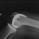 knee joint