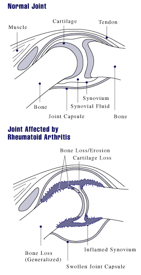 arthritis therapy exercise