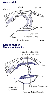 arthritis therapy exercise